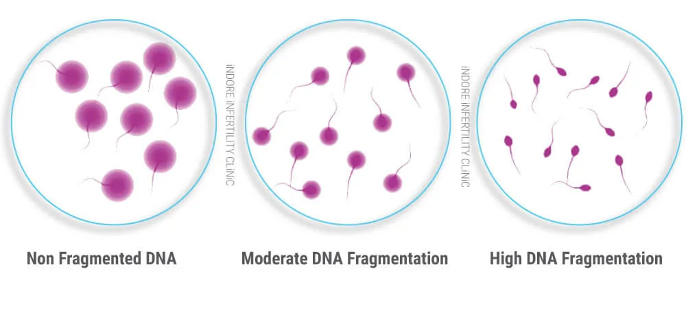 شکست DNA اسپرم: علل، علائم و درمانهای ممکن