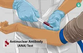 آزمایش ANA Profile( آنتی بادیهای هستهای) چیست؟