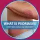 بیماری پسوریازیس