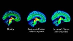 بیماری پارکینسون